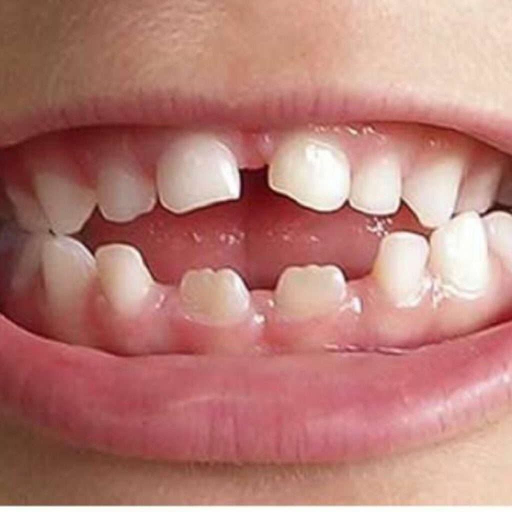 Close-up of a toddler’s ‘dummy teeth’ — front teeth pushed forward and an open bite from prolonged pacifier use